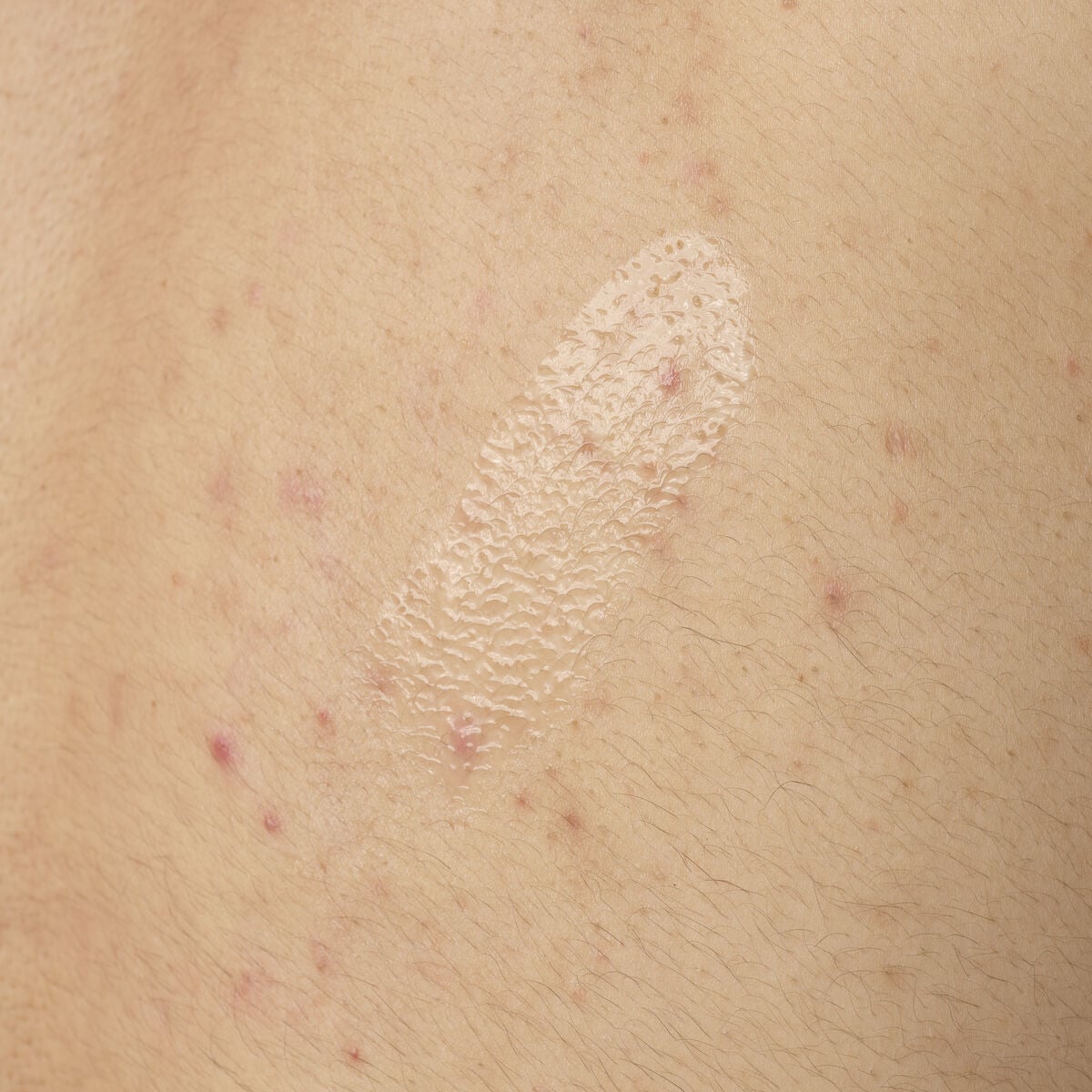 salicylic-acid-0-5-body-serum-r1 ORD-salicylic-acid-05-body-240ml-application.jpg