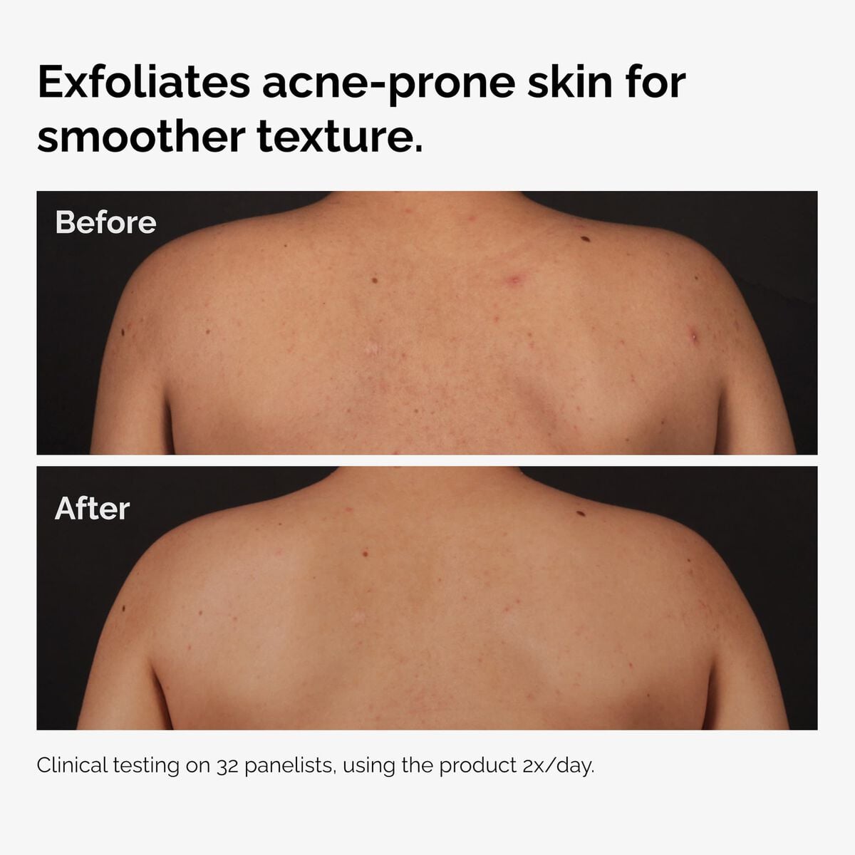 salicylic-acid-0-5-body-serum-r1 ord-salicylic-acid-body-serum-before-after-graphic-NA.jpg