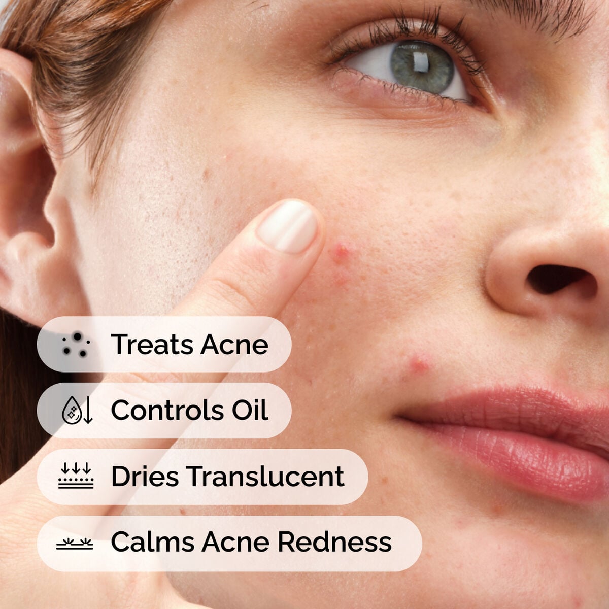 sulfur-10-powder-to-cream-concentrate-x3 ord-sulfur-10pct-powder-to-cream-concentrate-model-application-with-benefits-acne.jpg