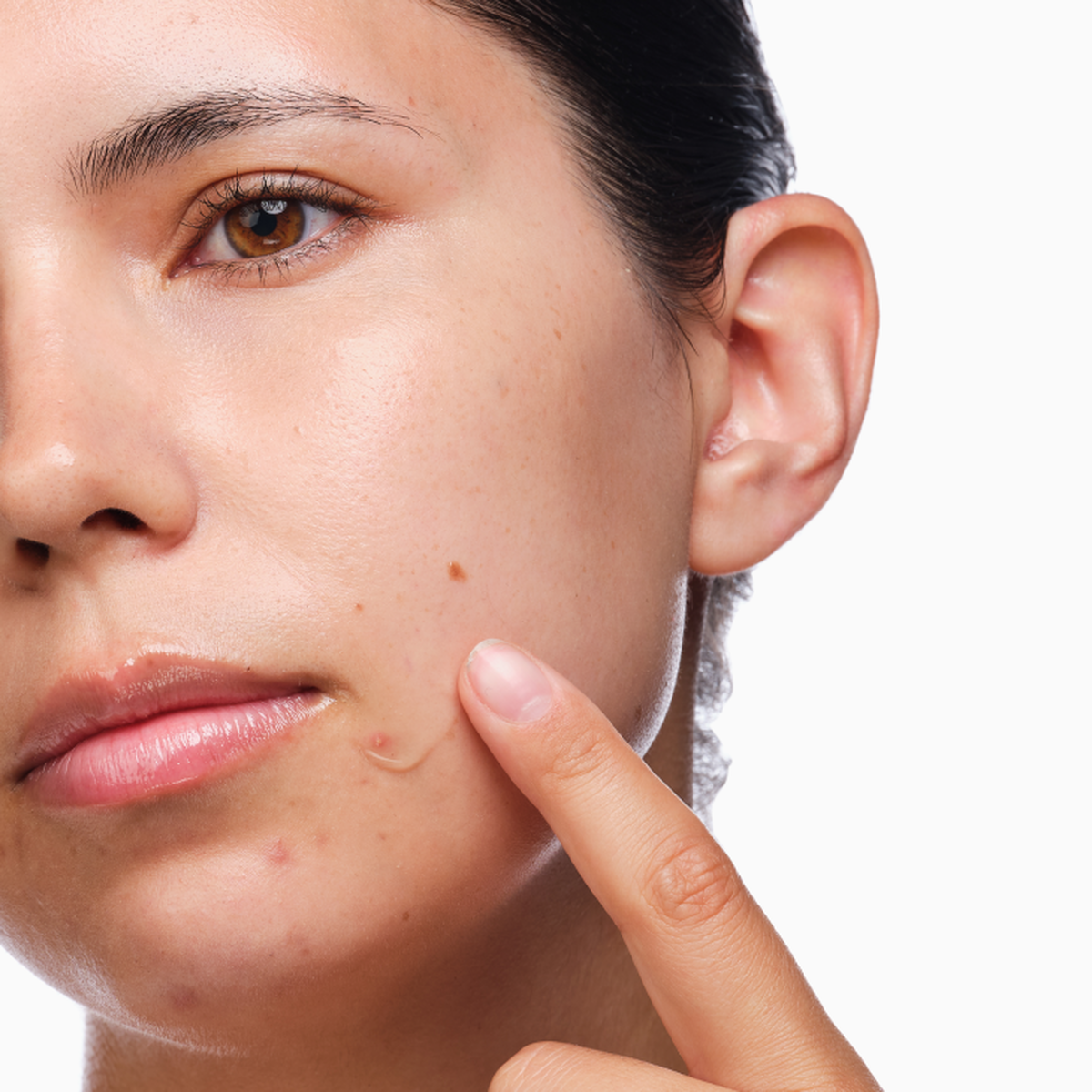 the-acne-set-l8 rdn-the-acne-set-application.png